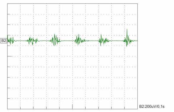 Essentieller Tremor - Tremoranalyse